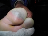 Die angefrorenen Zehen eines pakistanischen Trägers der Polnischen Gruppe
